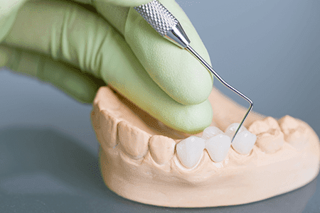 Policlínica Dental carillas dentales